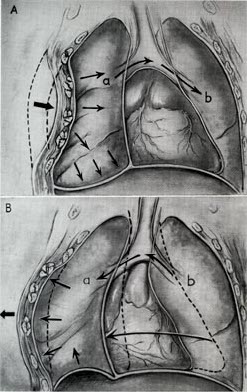 A depiction of flail chest, a very serious blunt chest injury