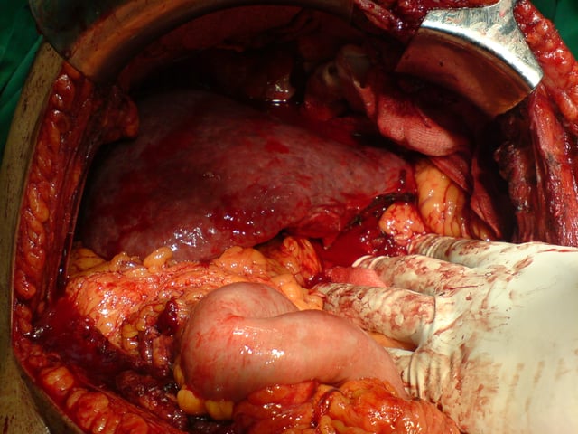 After resection of left lobe liver tumor