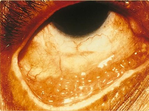 Conjunctivitis due to chlamydia.