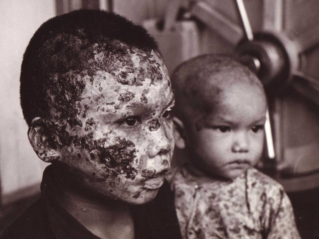 Napalm burn victims during the war being treated at the 67th Combat Support Hospital