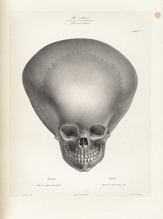 Skull of a hydrocephalic child (1800s)