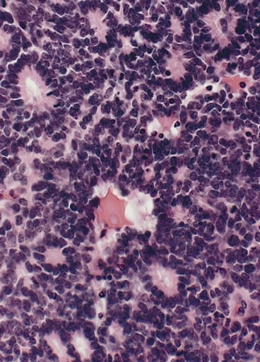 Flexner–Wintersteiner rosettes in Retinoblastoma.