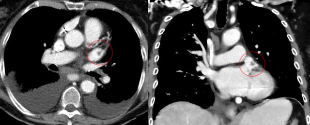 CT scan of the chest showing a thrombus in the left atrial appendage (left: axial plane, right: coronal plane)