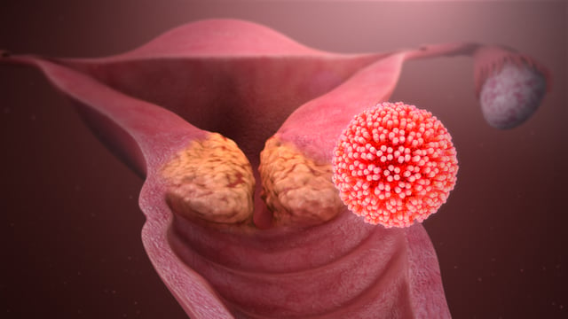 Artist's impression of cervical cancer caused by HPV.