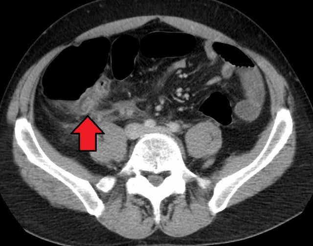 Appendicitis as seen on CT imaging