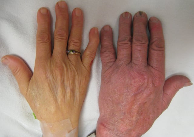 The hand of a person with severe anemia (on the left) compared to one without (on the right)