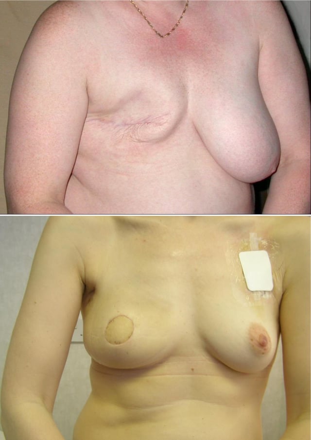 Conventional mastectomy (top); skin sparing mastectomy and latissimus dorsi myocutaneous flap reconstruction, prior to nipple reconstruction and tattooing * (bottom)*.