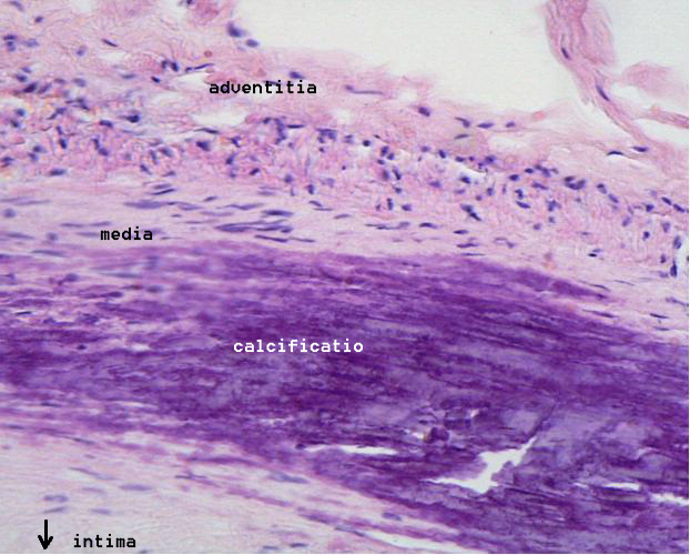 Microphotography of arterial wall with calcified (violet color) atherosclerotic plaque (hematoxylin and eosin stain)