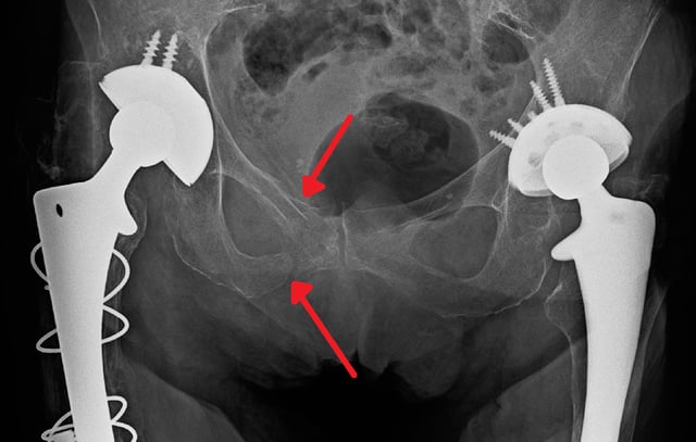 An X-ray showing a fracture of the inferior and superior pubic rami in a patient with previous hip replacements