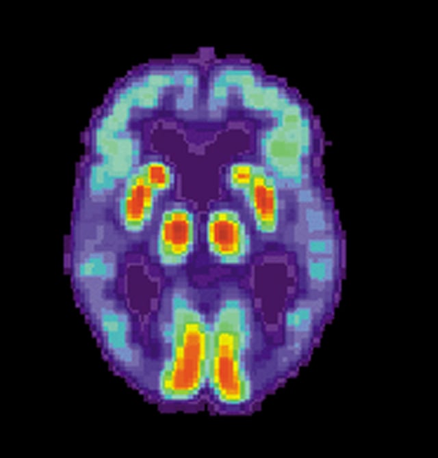 PET scan of the brain of a person with AD showing a loss of function in the temporal lobe