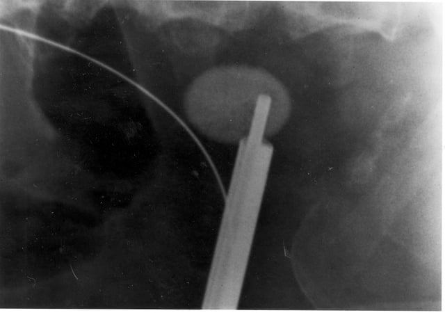 A kidney stone at the tip of an ultrasonic stone disintegration apparatus
