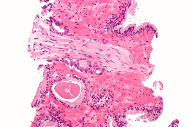 Micrograph demonstrating perineural invasion of prostate cancer. H&E stain.