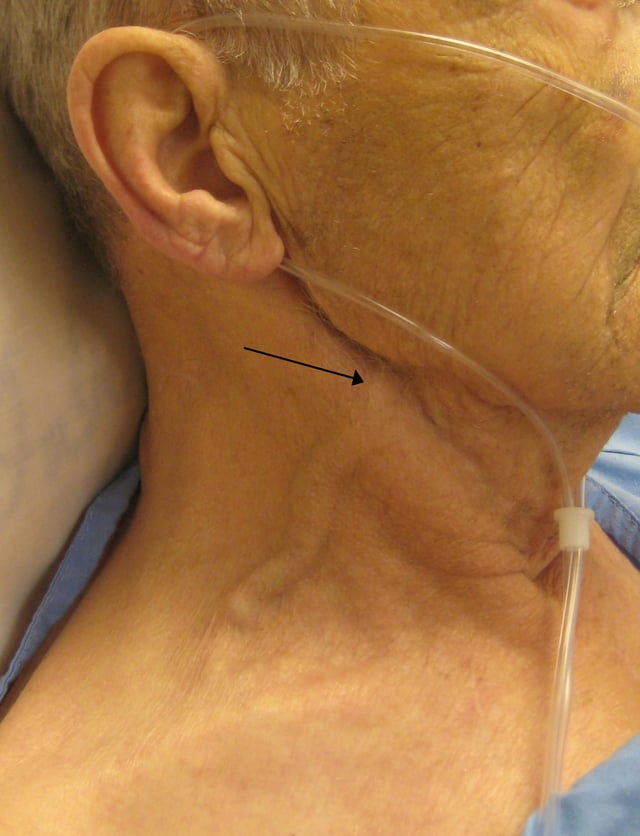 A man with congestive heart failure and marked jugular venous distension. External jugular vein marked by an arrow.