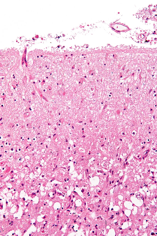 Micrograph of the superficial cerebral cortex showing neuron loss and reactive astrocytes in a person that has had a stroke. H&E-LFB stain.