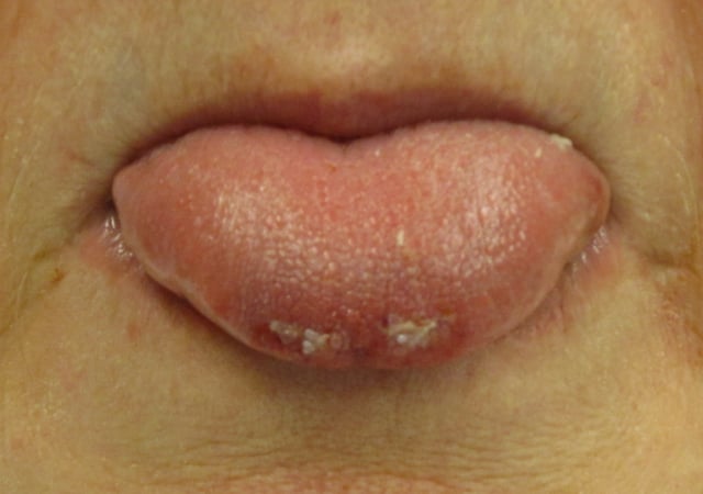 A bite to the tip of the tongue due to a seizure