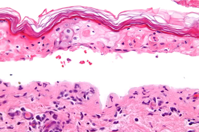 Micrograph showing full-thickness epidermal necrosis with a basket weave-like stratum corneum and separation of the dermis and epidermis, skin biopsy, H&E stain
