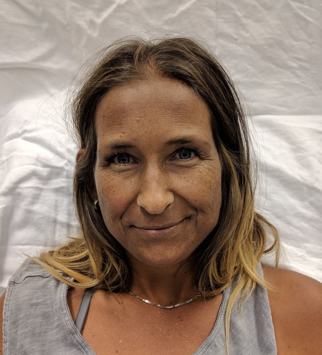 Hyperpigmentation as seen in a woman with Addison's disease