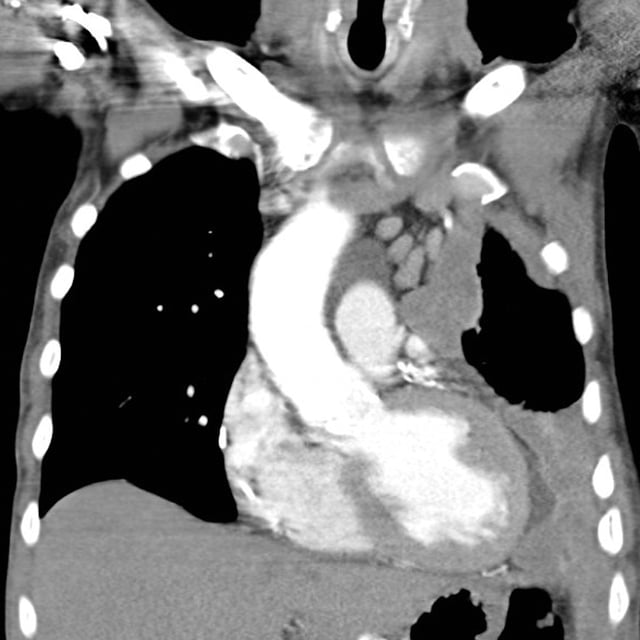 Left-sided mesothelioma (seen on the right of the picture): chest CT