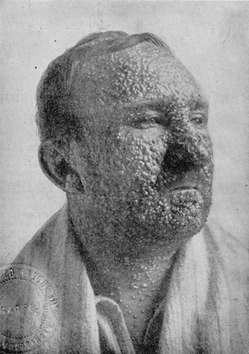 A person with smallpox in the United States, 1912