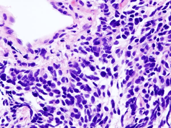 Small-cell lung carcinoma (microscopic view of a core needle biopsy)