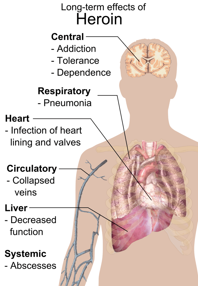 Long-term effects of intravenous usage, including – and indeed primarily because of – the effects of the contaminants common in illegal heroin and contaminated needles.