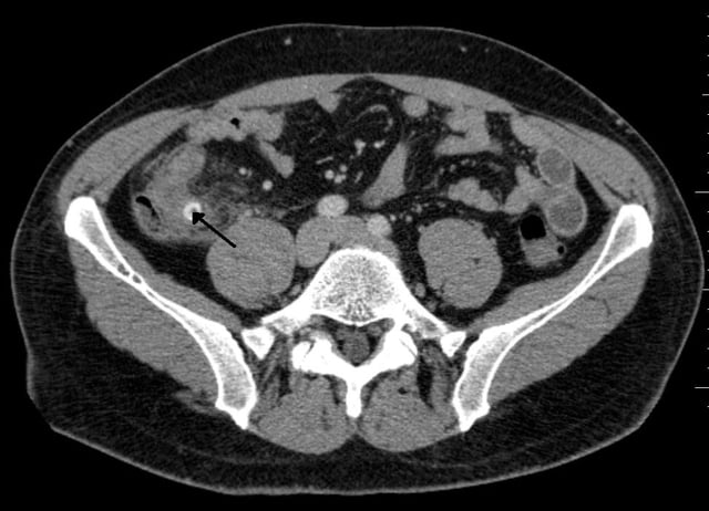 A fecalith marked by the arrow that has resulted in acute appendicitis.