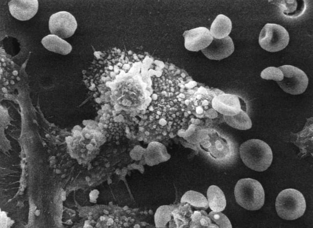 Macrophages have identified a cancer cell (the large, spiky mass). Upon fusing with the cancer cell, the macrophages (smaller white cells) inject toxins that kill the tumor cell. Immunotherapy for the treatment of cancer is an active area of medical research.