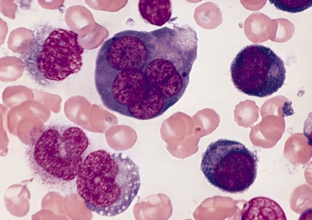 A bone marrow smear from a case of erythroleukemia. The large cell in the top center is an abnormal erythroblast: it is multinucleated, with  megaloblastoid nuclear chromatin This is diagnostic of erythroleukemia.