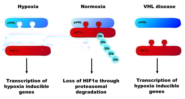 The regulation of HIF1α by pVHL. Under normal oxygen levels, HIF1α binds pVHL through 2 hydroxylated proline residues and is polyubiquitinated by pVHL. This leads to its degradation via the proteasome. During hypoxia, the proline residues are not hydroxylated and pVHL cannot bind. HIF1α causes the transcription of genes that contain the hypoxia response element. In VHL disease, genetic mutations cause alterations to the pVHL protein, usually to the HIF1α binding site.