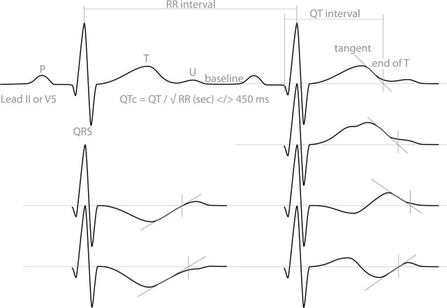 Measurement of the QT interval with normal and prolonged QT intervals