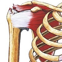 Here is where the rotator cuff is located, and what a tear would look like in the shoulder