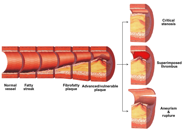 Progression of atherosclerosis to late complications.