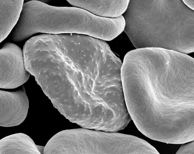 Electron micrograph of a Plasmodium falciparum-infected red blood cell (center), illustrating adhesion protein "knobs"