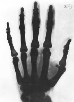 X-ray of a hand, taken by Tesla