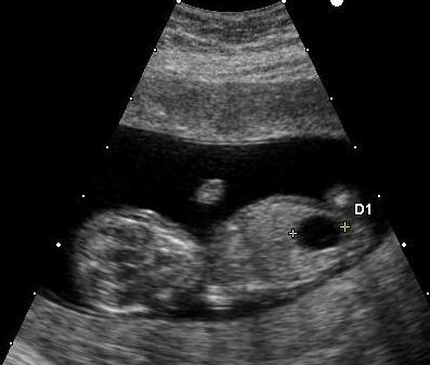 Ultrasound of fetus with Down syndrome showing a large bladder