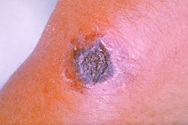 Anthrax skin lesion