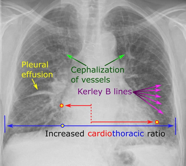 Chest radiograph of a lung with distinct Kerley B lines, as well as an enlarged heart (as shown by an increased cardiothoracic ratio, cephalization of pulmonary veins, and minor pleural effusion as seen for example in the right horizontal fissure. Yet, there is no obvious lung edema. Overall, this indicates intermediate severity (stage II) heart failure.