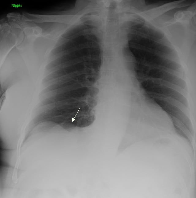 Primary pulmonary sarcoma in an asymptomatic 72-year-old male.