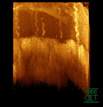 (image rotating (1.1 mb)*) Optical coherence tomogram of fingertip, depicting stratum corneum (~500 µm thick) with stratum disjunctum on top and stratum lucidum (connection to stratum spinosum) in the middle. At the bottom superficial parts of the dermis. Sweatducts are clearly visible.