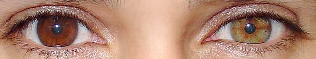 An example of complete heterochromia. The subject has one brown eye and one hazel eye.