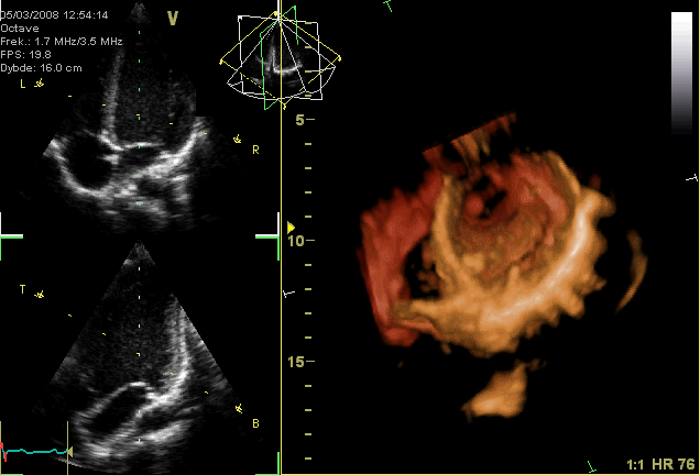 3D echocardiogram showing the mitral valve (right), tricuspid and mitral valves (top left) and aortic valve (top right). The closure of the heart valves causes the heart sounds.
