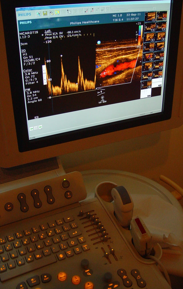 Colour flow ultrasonography (Doppler) of a carotid artery – scanner and screen