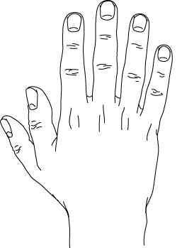 Preaxial polydactyly