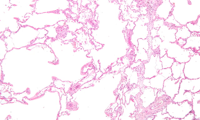 Micrograph showing emphysema (left – large empty spaces) and lung tissue with relative preservation of the alveoli (right)