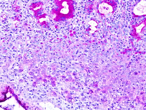 Gastric signet ring cell carcinoma histopathology, PAS stain