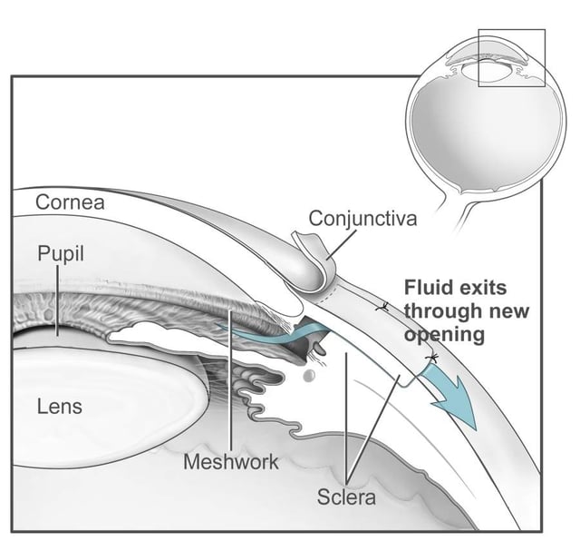 Conventional surgery to treat glaucoma makes a new opening in the trabecular meshwork, which helps fluid to leave the eye and lowers intraocular pressure.