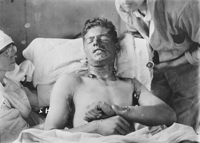 A Canadian soldier with mustard gas burns, c. 1917–1918