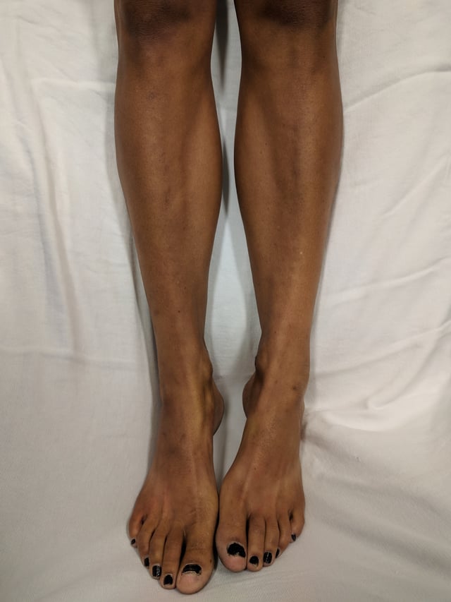 Legs of a Caucasian woman with Addison's disease