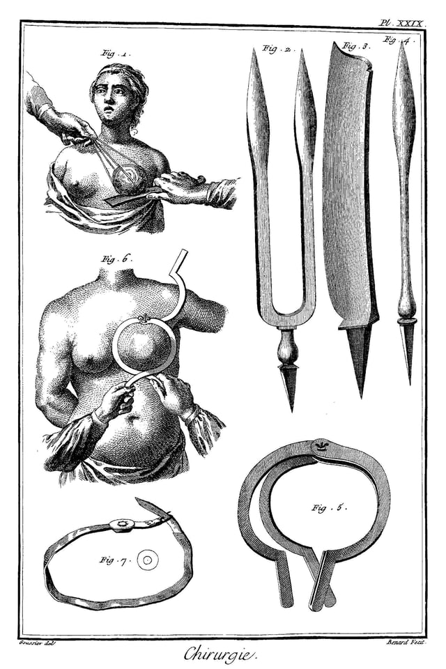 Breast cancer surgery in 18th century