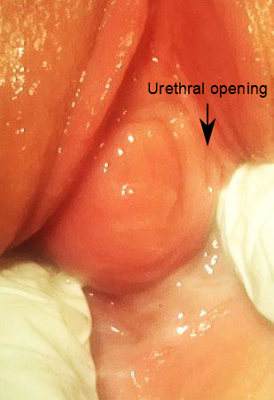 A Skene's duct cyst, pressing the urethral opening towards the right side of the image.